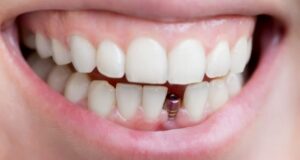 Implant dentaire